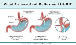 10 home remes for acid reflux and