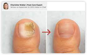 destroy nail fungus even if nothing