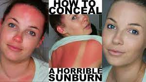 conceal an awkward sunburn