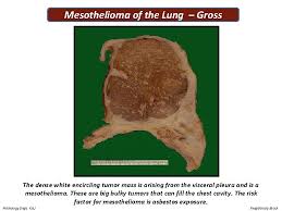 The chance of dying of a malignancy (mesothelioma or lung cancer) versus a. Second Practical 1 Tuberculosis 2 Cancer Of The