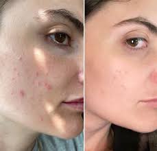 acne treatments in virginia washington