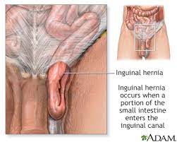 inguinal hernia discharge information