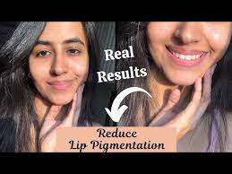how to get rid of lip pigmentation
