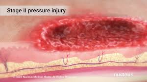 pressure injuries you