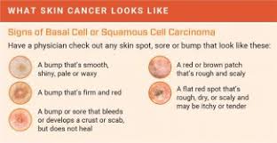 Precancerous skin lesions known as actinic keratoses. How To Detect Skin Cancer Roswell Park Comprehensive Cancer Center