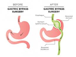 $25,571 is the average cost of gastric bypass. Laparoscopic Gastric Bypass Surgery In Turkey Find Best Hospitals Cost Estimate Reviews