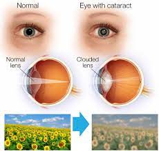 what are the symptoms of cataracts