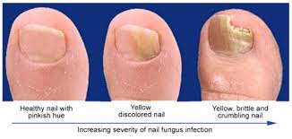 causes and treatments of toenail fungus