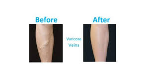 Our staff is happy to assist with questions you may have. Varicose Vein Therapy And Varicose Vein Treatment In Cincinnati Cincinnati Oh Rejuveination