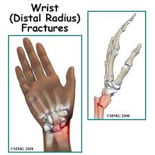 physiotherapy in calgary for wrist pain