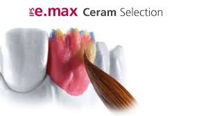 Ips E Max Ceram Selection