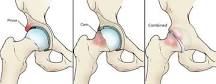 Image result for icd 10 code for left hip femoroacetabular impingement