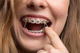Recently get a braces but now it's hurting you? Interarch Elastics Are Important To A Successful Orthodontic Outcome Manilla Orthodontics