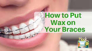 Cleaning candle wax from hardwood floors. How To Put Wax On Your Braces