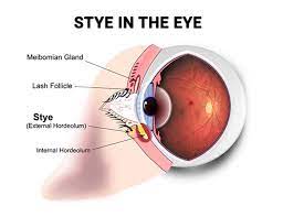 stye treatment in nyc vitreous retina
