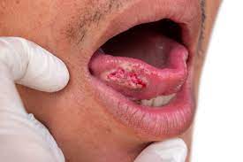 mouth cancer signs symptoms causes