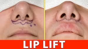 lip lift full procedure in 4k graphic