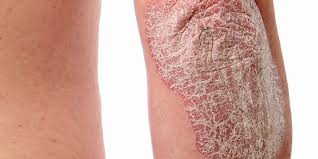 Read how diet impacts psoriasis, whether it's contagious, and the outlook for cure. Psoriasis Everything You Need To Know About This Chronic Skin Condition Apex Dermatology Skin Surgery Center Cleveland Oh Dermatology