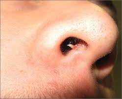 firm and tender growth in right nostril