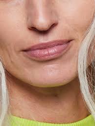 how to get rid of lip lines according