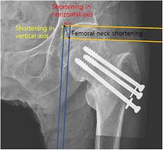 fem neck fractures