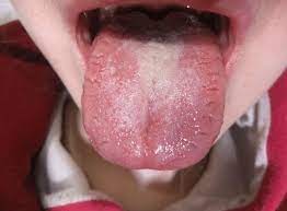 enlarged fissured tongue