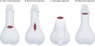 penile prosthesis implant
