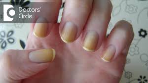 what can cause yellow discoloration of