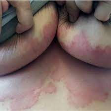 Intertrigo is similar to inverse psoriasis, and also appears in the folds of skin around the: Candida Intertrigo On The Infra Mammary Folds Of A Middle Aged Woman Download Scientific Diagram