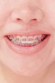 swollen gums braces tips from your