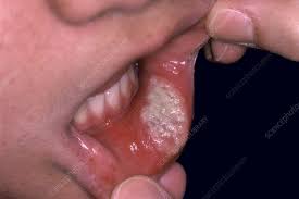 canker sore stock image c052 2063
