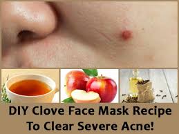 diy clove face mask recipe to clear