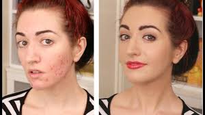 how to cover acne scarring my full