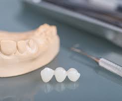 Čine ju dvije ili više međusobno povezanih zubnih krunica. Zubni Most Cijena I Ugradnja Stimac Centar Dentalne Medicine