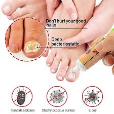 nail foot toe nail fungus removal