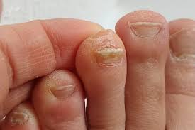 types of toenail fungus pictures