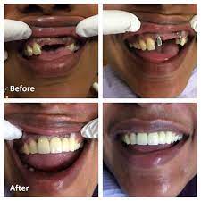 single tooth dental implant ottawa
