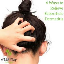 4 natural remes for seborrheic