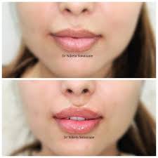 lip fillers in mumbai cost before