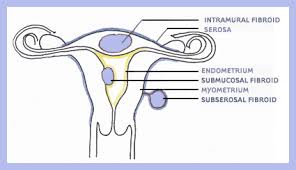center for uterine fibroids
