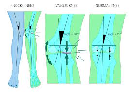 distal fem osteotomy valgus knee