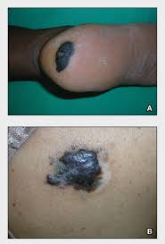 melanoma mdedge dermatology