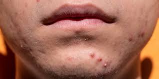 acne around the mouth causes