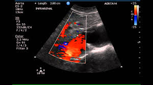 Case Studies and Presentations Abdominal Ultrasound picture  radiological approach to conge   slidesharecdn com 