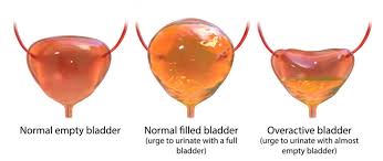 overactive bladder center for