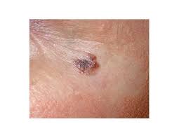 See melanoma pictures to determine which skin characteristics may be of concern. Exactly What Cancer Looks Like Glamour