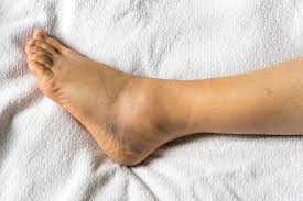 12 causes of swollen ankles feet why