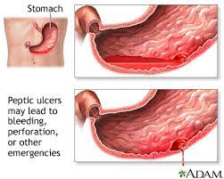 peptic ulcer disease stomach ulcers