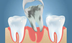 5 benefits of wisdom teeth removal