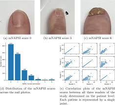 deepnapsi multi reader nail psoriasis